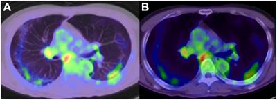 Oncology and cardiology positron emission tomography/computed tomography faced with COVID-19: A review of available literature data